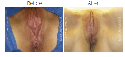 Comparison of a vulva before and after labiaplasty surgery.