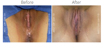 Comparison of a vulva before and after a surgical procedure.