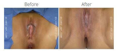 Before and after photos of a surgical procedure; the area is a vulva, the
