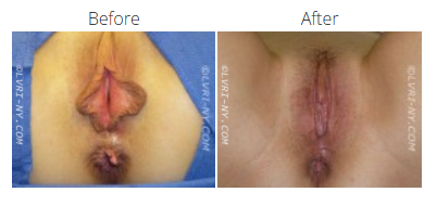 A before and after comparison of a female genital area, showing surgical results.