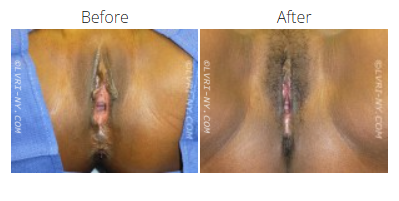 Comparison of a vulva before and after a procedure. The after image shows surgical incision with reduced size.