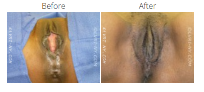 Before and after view of a vulva. The “before” shows a surgical procedure. The “after” shows the healed result.