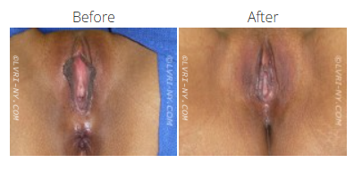 Comparison of vulva, before and after a procedure, showing cosmetic changes.