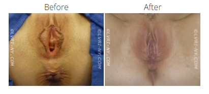 Comparison of vulva before and after labiaplasty.