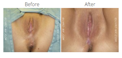 Comparison of before and after labiaplasty. The
