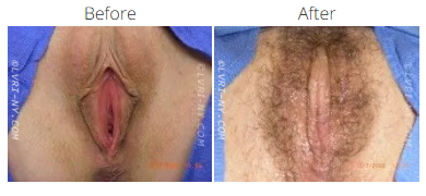 A comparison of a vulva before and after hair removal.