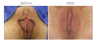 Before and after photos of a vulva, showing a change in the labia appearance.