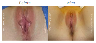 Comparison of before and after labiaplasty. The