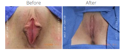 Comparison of labiaplasty before and after images.