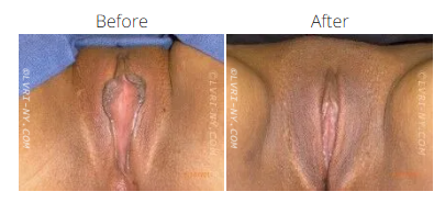 Before and after view of a vulva. The 'before' shows an enlarged clitoris, 'after' shows a reduced clitoris.