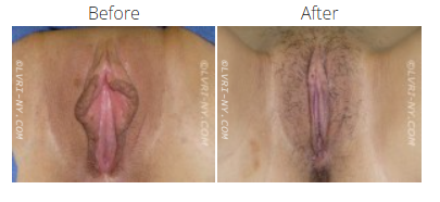 Before and after view of a vulva, showing a change in appearance after a procedure.