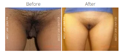 Comparison of pubic hair before and after, possibly hair removal treatment.