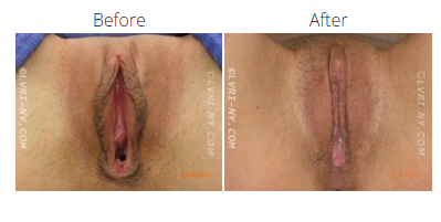 Before and after images of a vulva, showing a surgical procedure.
