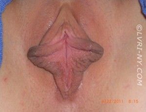 Close-up of a vulva, showing the labia and clitoris. Pink and brown skin tones.