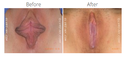 Comparison of a vulva before and after a procedure.