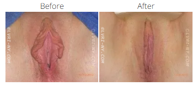 Comparison of a vulva before and after labiaplasty.