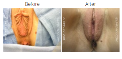 Comparison of labia, before and after a procedure.
