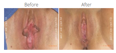 Before and after photos of a surgical procedure on a vulva. The “before” photo shows tissue with a dark discoloration, while the “after” photo shows a clean area.