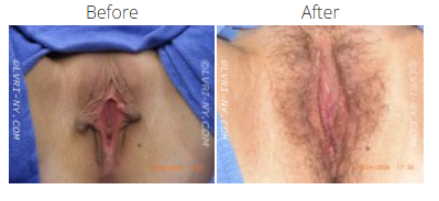 Comparison of a vulva before and after a procedure, with changes in appearance and hair.