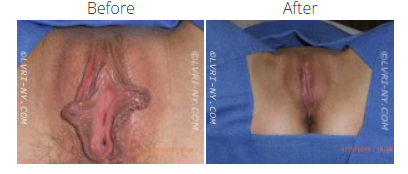 Comparison of female genitalia before and after surgery.