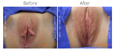 Comparison of a vulva before and after a labiaplasty, showing changes in appearance.