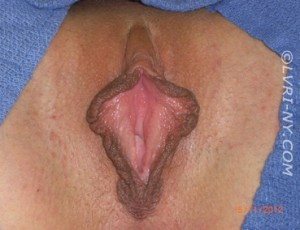Close-up view of female genitalia. Pink inner lips with brown outer lips, on a blue surgical drape.