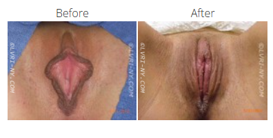 Before and after photos of vulva, showing a change in appearance after a procedure.