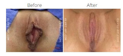 Comparison of vulva appearance: before and after labiaplasty.