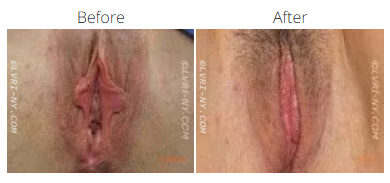 Before and after images of a vulva, showing a surgical procedure.