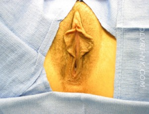 Close-up of a vulva with exposed labia, skin tones are brown and yellow, set against a blue fabric.