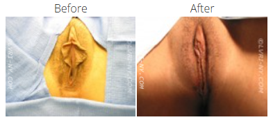 Comparison of labia, labeled