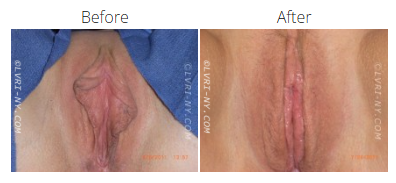 Before and after photos of a labiaplasty. The before photo shows excess labia, while the after photo shows reduced labia.
