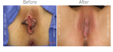 Comparison of a vulva before and after a procedure, showing changes in labia appearance.