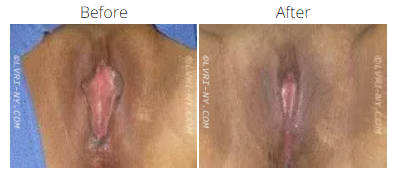 Before and after images of a vulva. The