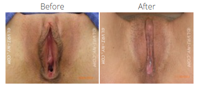 Comparison of female genitalia before and after surgery, demonstrating a change in appearance.