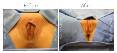Before and after images of a vulva, showing a labiaplasty procedure.