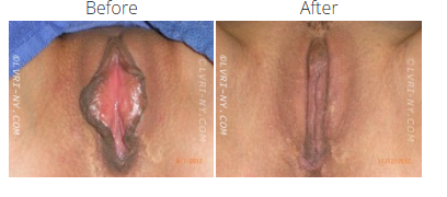 Comparison of vulva before and after surgery. The