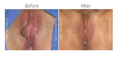 Before and after images of a vulva, showing a reduction in labia size after surgery.