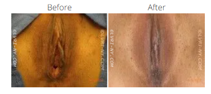 Before and after photo of a vulva, showing a change in skin appearance.