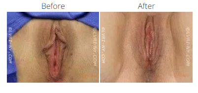 Comparison of a vulva before and after a cosmetic procedure.