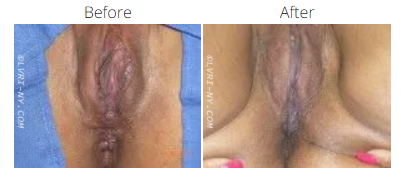 Comparison of a vulva before and after a procedure.