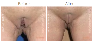 Comparison of female genitalia before and after labiaplasty surgery.
