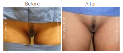 Side-by-side comparison of female genitalia