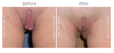 Comparison of before and after labiaplasty. The