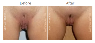 Comparison of vulva before and after a medical procedure.