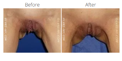 Comparison of vulva before and after labiaplasty.