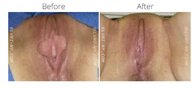 Comparison of vulva, before and after a surgical procedure. Reddish-brown skin.