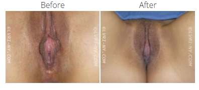 Comparison of female genitalia before and after a medical procedure.