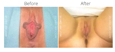Comparison of female genitalia before and after cosmetic surgery.