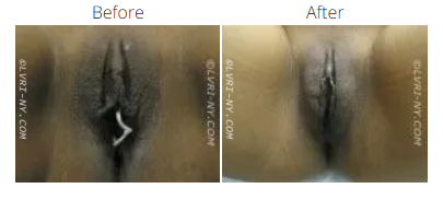 A medical image comparing the appearance of a vulva before and after a procedure.